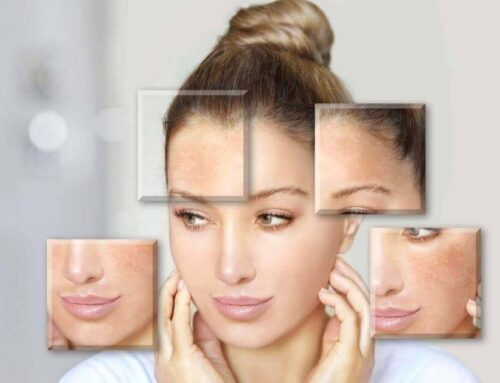 Can Morpheus8 Improve Acne Scars and Uneven Texture?