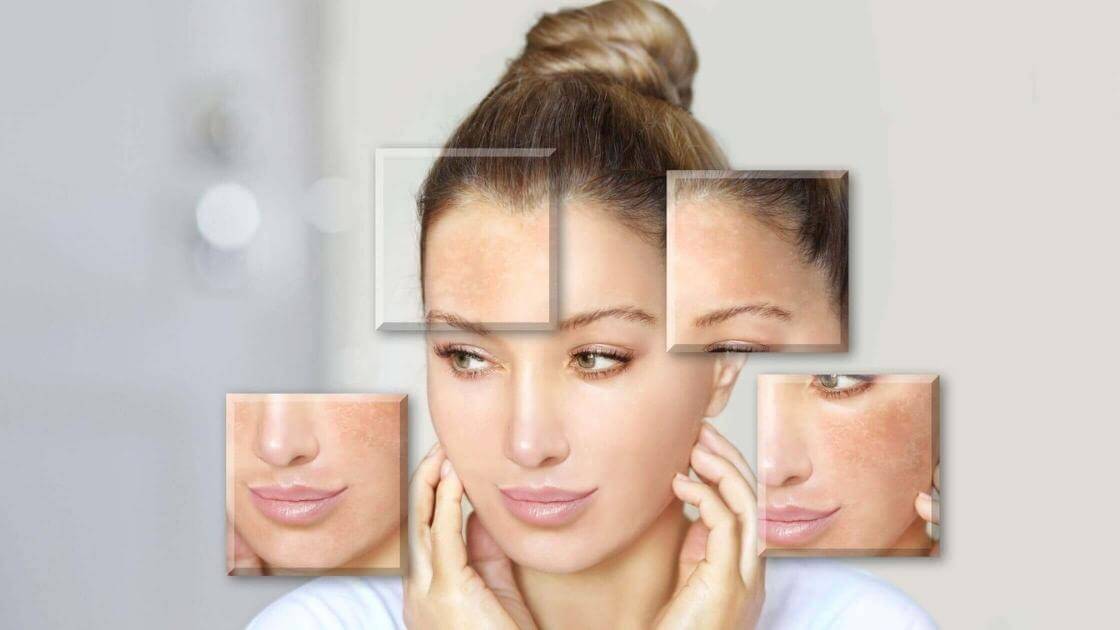 Can Morpheus8 Improve Acne Scars and Uneven Texture?